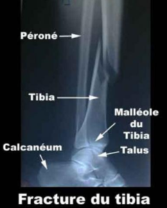 La fracture fait partie des séquelles pouvant impliquer plusieurs opérations chirurgicales. Le préjudice Souffrances Endurées et tout les préjudices liés à l'activitité professionnels sont à indemniser.